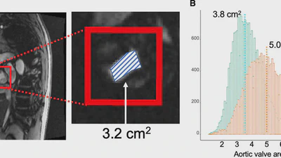 Cardiac Imaging of Aortic Valve Area From 34287 UK Biobank Participants Reveals Novel Genetic Associations and Shared Genetic Comorbidity With Multiple Disease Phenotypes featured image